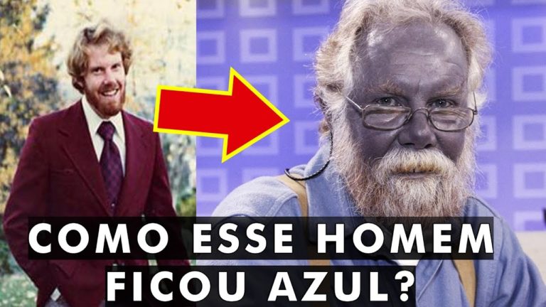 Anomalias Genéticas no Homem