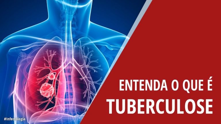 Tuberculose