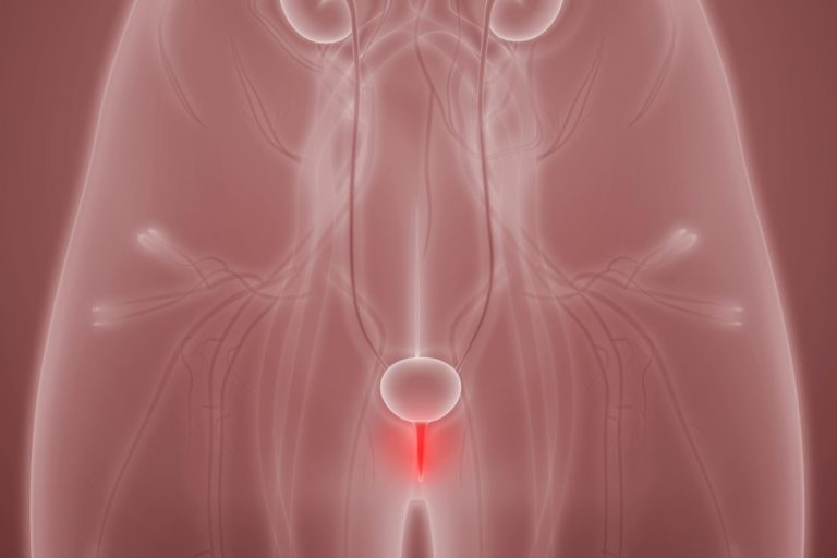 Uretrite