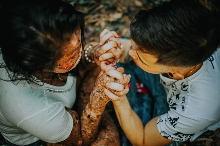 Xeroderma Pigmentoso