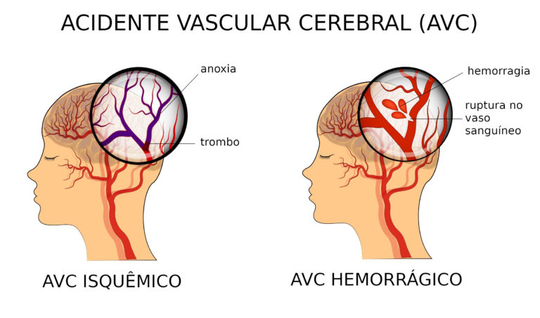 Um Acidente Vascular Cerebral (AVC)