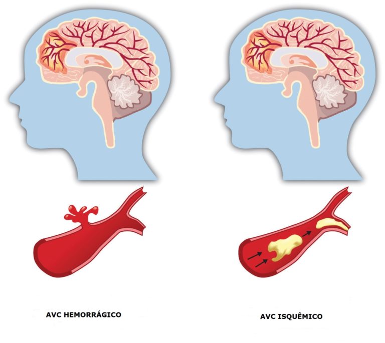 ACIDENTE VASCULAR CEREBRAL – AVC