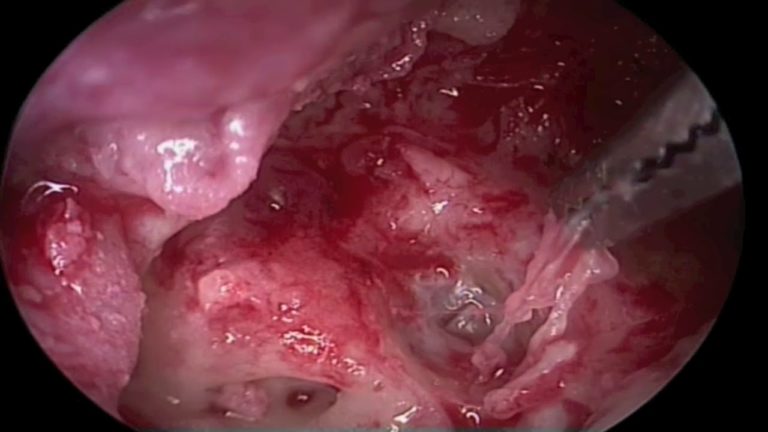 COLESTEATOMA