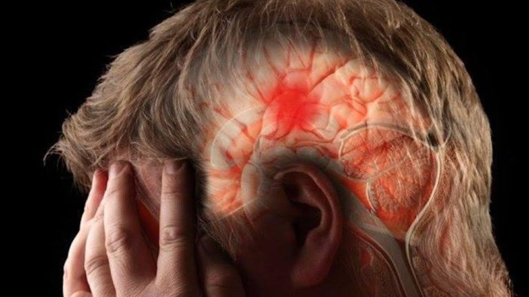 Derrame Cerebral