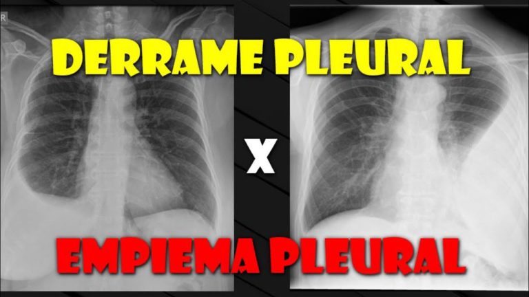 Abscesso Pulmonar e Empiema Pleural