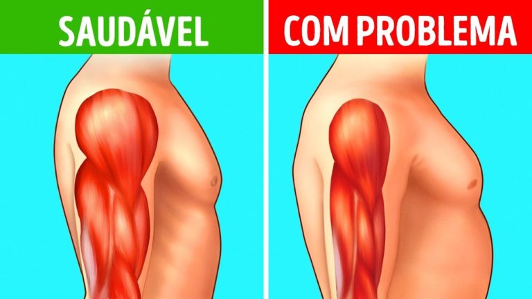 O QUE É DISTROFIA MUSCULAR MIOTÔNICA