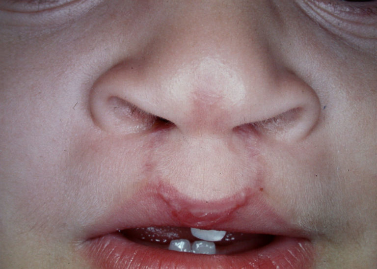 TRATAMENTO DA FISSURA LABIAL BILATREAL