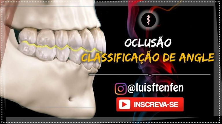 CLASSIFICAÇÃO DAS MALOCLUSÕES E TIPOS DE MORDIDA