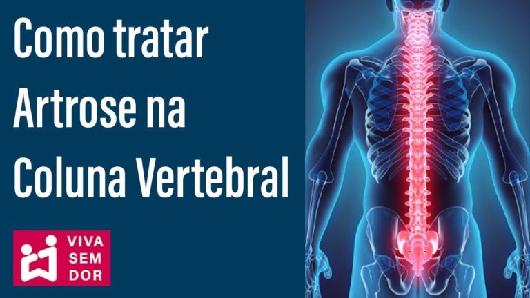 ARTROSE VERTEBRAL