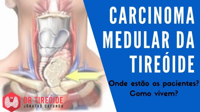 CARCINOMA MEDULAR DA TIREOIDE