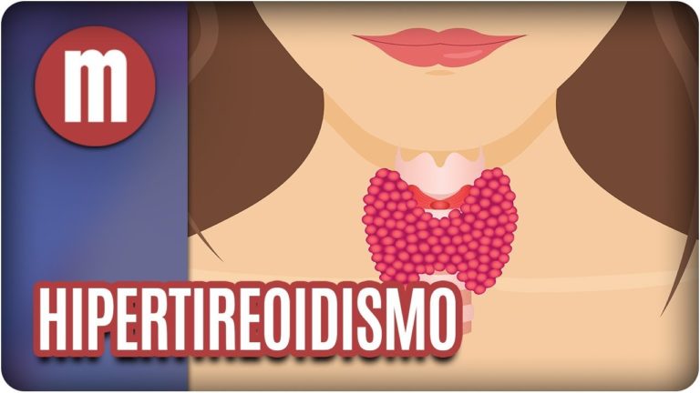 HIPERTIREOIDISMO