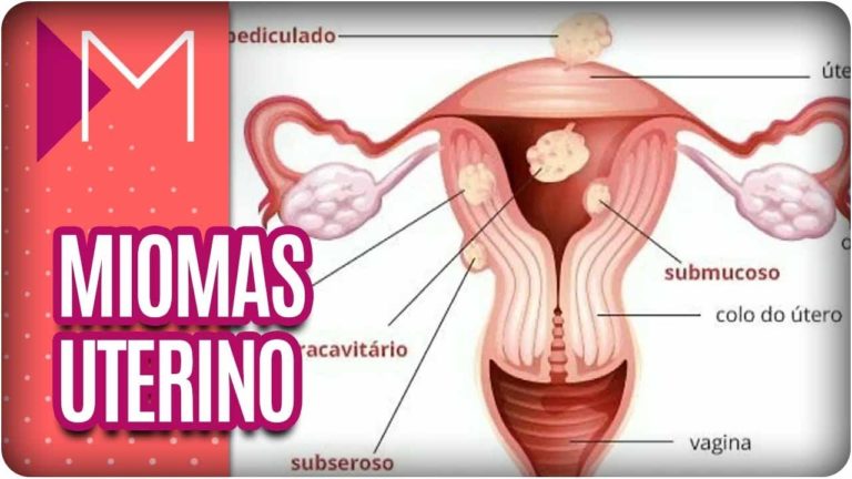 MIOMA UTERINO