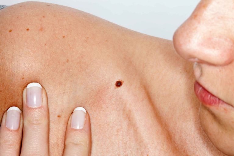 NEOPLASIA MALIGNA – CANCER