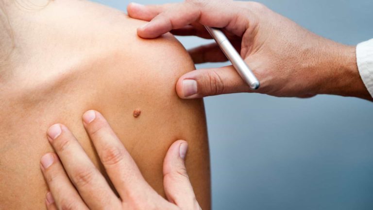 MELANOMA