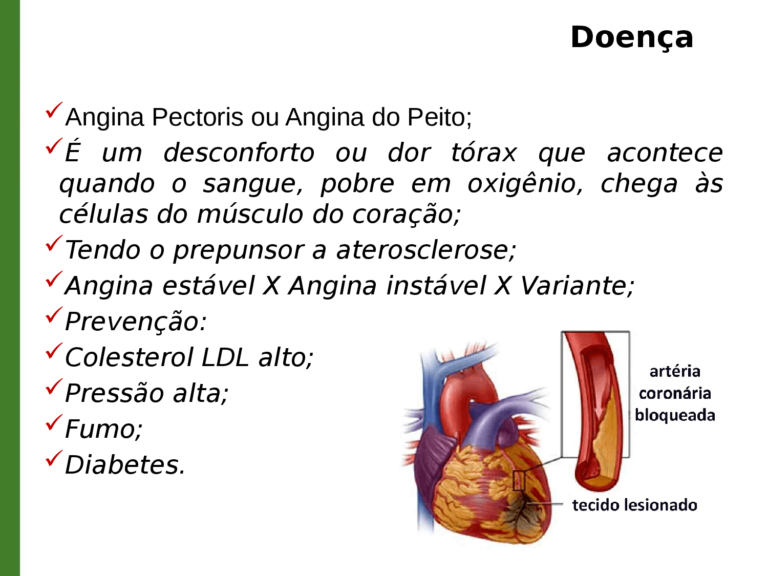 ANGINA