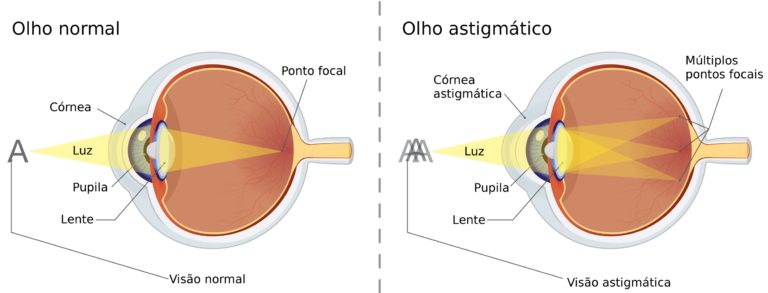 ASTIGMATISMO