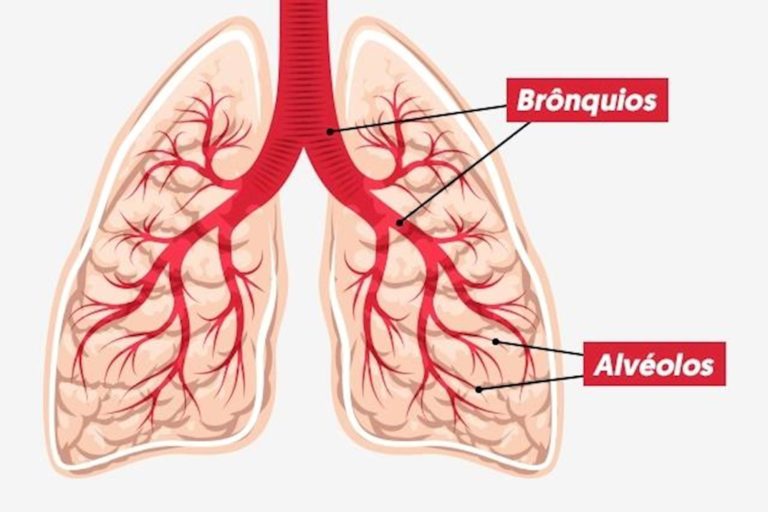 BRONCOPNEUMONIA