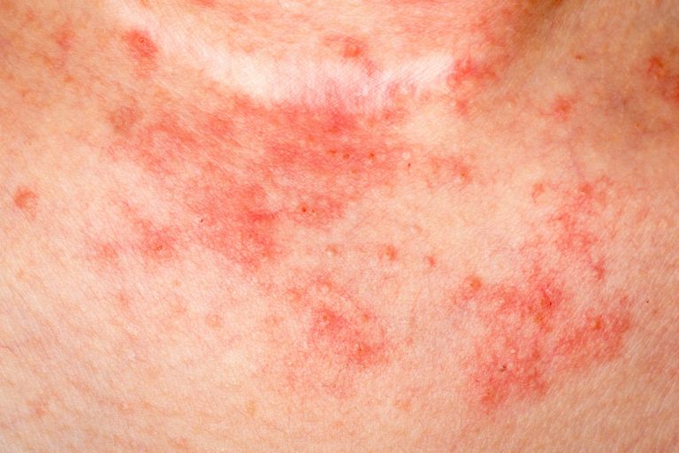 ECZEMA