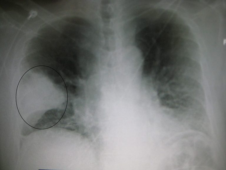 PNEUMONIA