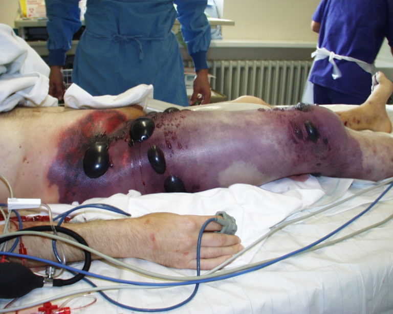 GANGRENA