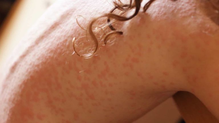 MELANOMA DA PELE