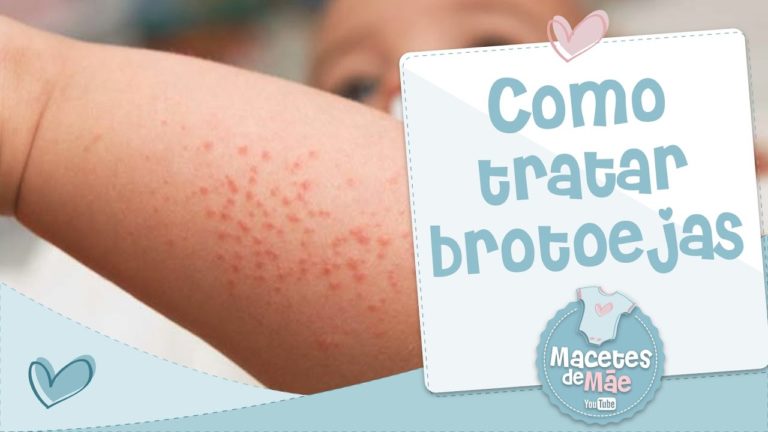 BROTOEJA – COMO TRATAR E PREVENIR