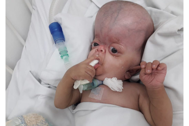 TRATAMENTO DA SINDROME DE CROUZON