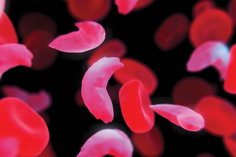 ANEMIA FERROPRIVA GESTACIONAL
